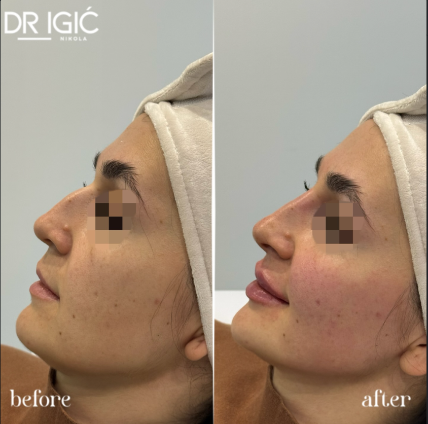 Pre i posle tretmana