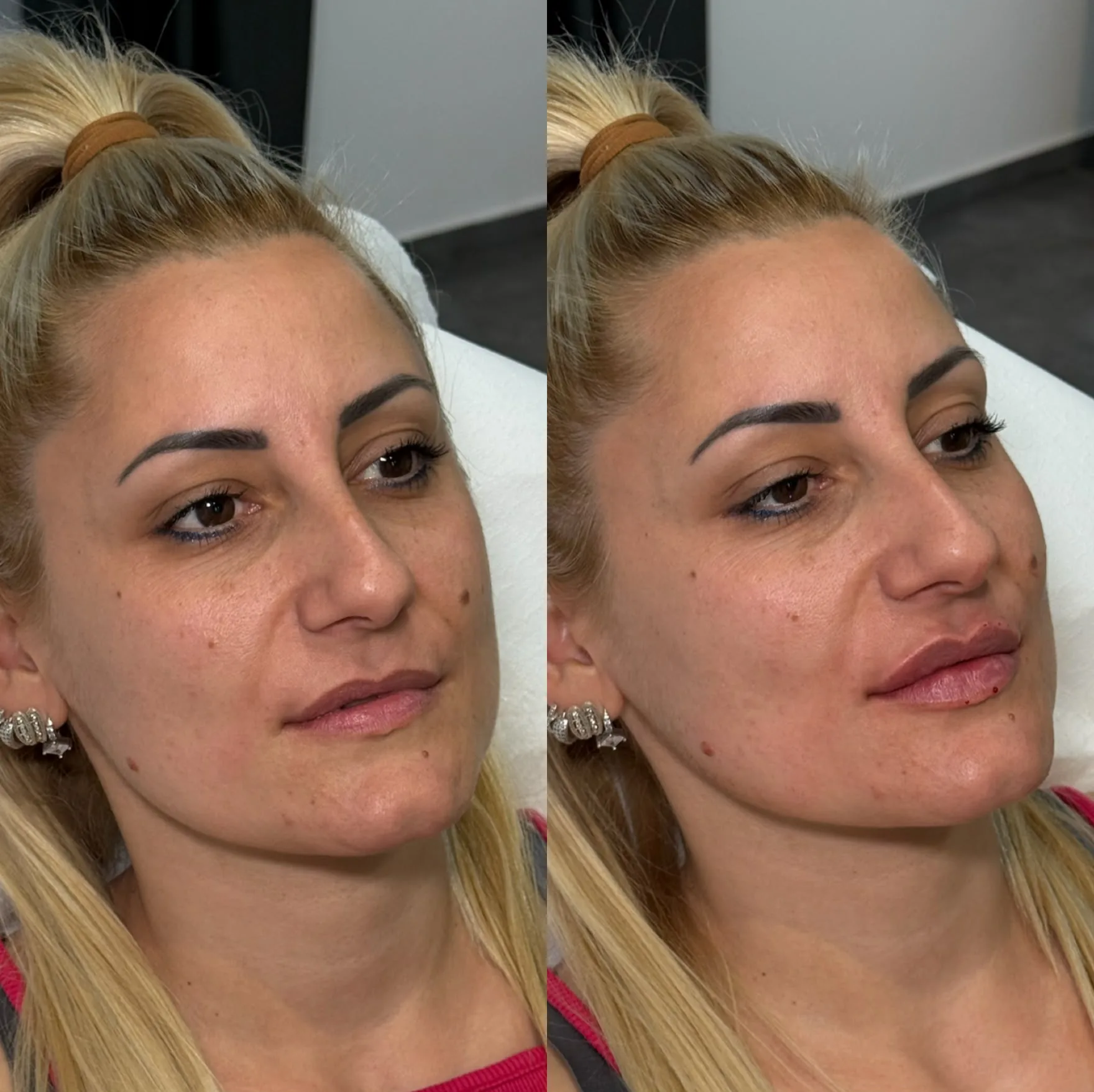 Harmonizacija profila lica pre i posle estetskog tretmana
